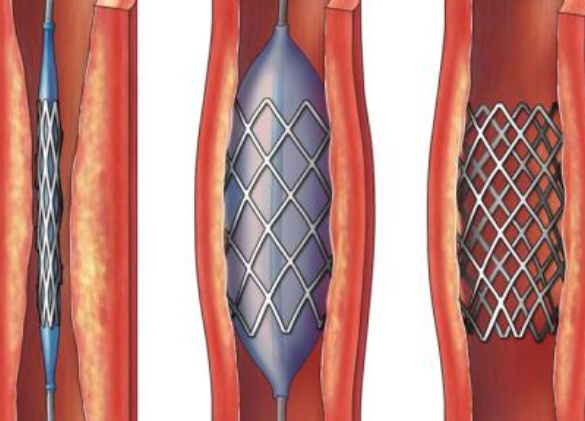 好消息！700元冠脉支架来了带量采购结果在凯发k8省正式落地执行